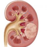 Profile picture of Barry McGuire Kidney Cancer Treatment